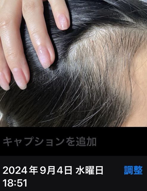 薄毛女子のそりこみお手当て5か月後