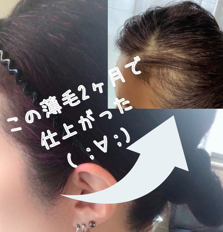 薄毛対策に使った和製パントガール3ヶ月目に突入