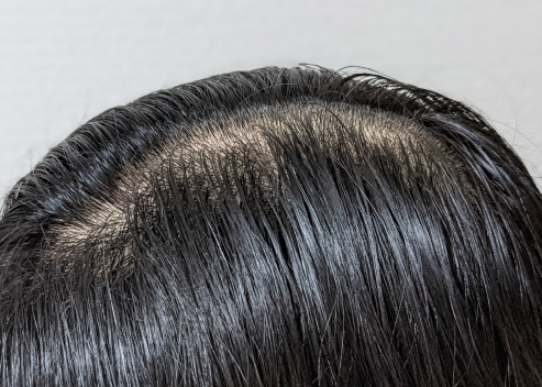 女性の更年期薄毛