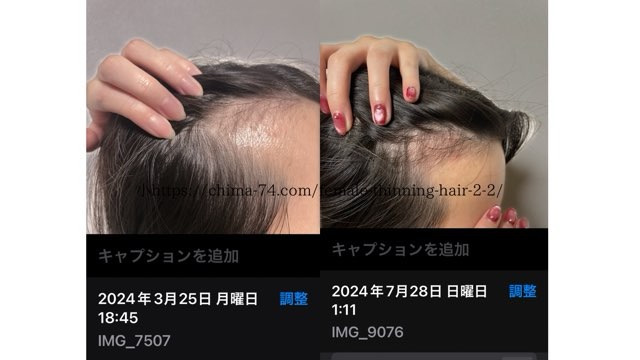 脂性肌M字薄毛の改善