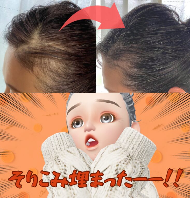 女性の薄毛抜け毛対策4か月目突入報告