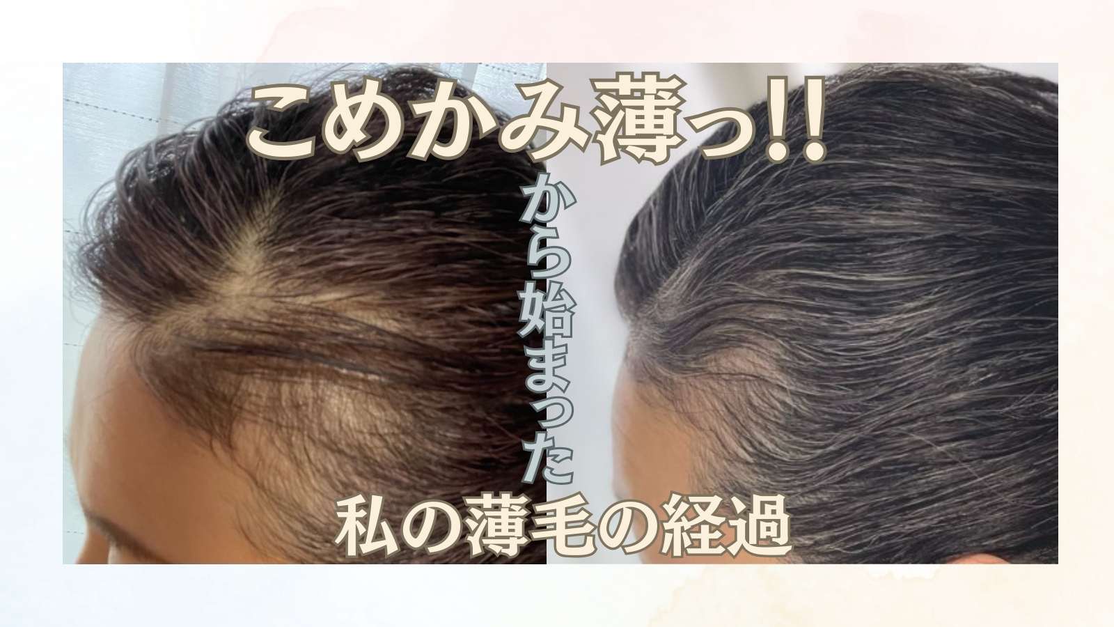 こめかみの薄毛は治るのか？育毛剤やサプリ試した経過まとめました
