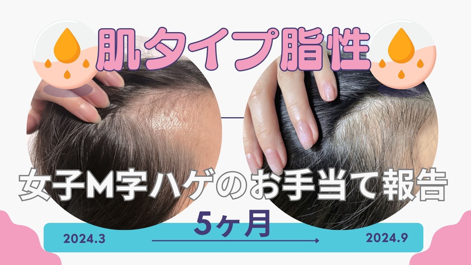 M字ハゲ悩みの脂性肌娘にした元薄毛母が伝えた大切な事